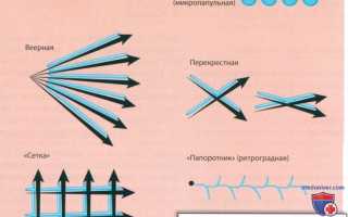 Техника введения филлеров: болюсная, канюльная, веерная и линейно-ретроградная