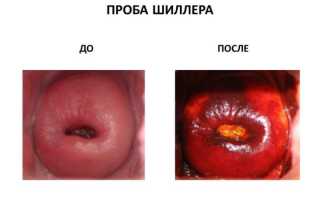 Проба Шиллера: интерпретация результатов и способ выполнения процедуры