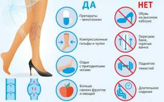 Варикоз: симптомы, лечение, профилактика