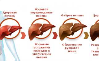 Цироз печени: страшный диагноз