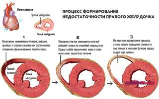 Что такое коронарка