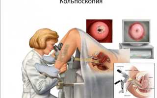 Железисто фиброзный полип эндометрия лечение после удаления