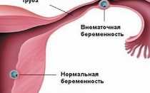 Сможет ли тест определить внематочную беременность