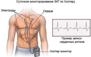 Нарушение внутрипредсердной проводимости что это такое