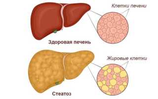 Причины и последствия ожирения печени