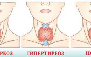Чем опасны избыток и недостаток гормонов щитовидной железы