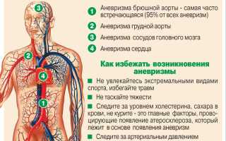 Аневризма: болезнь сердечно-сосудистой системы, или «Бомба замедленного действия»