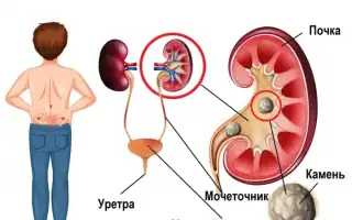 Как вырастить камни в почках