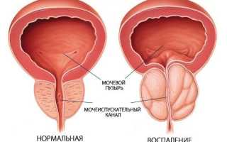 Лечение простатита
