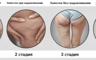 Целлюлит — что это такое и главные причины, по которым он возникает?