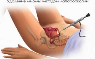 Что такое миома матки и ее удаление методом лапароскопии